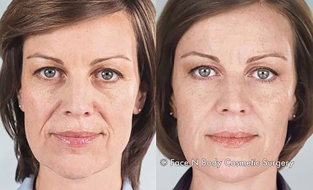 Injectables Before & After