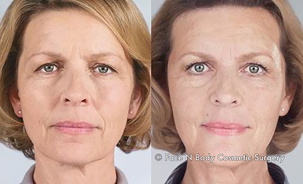 Injectables Before & After