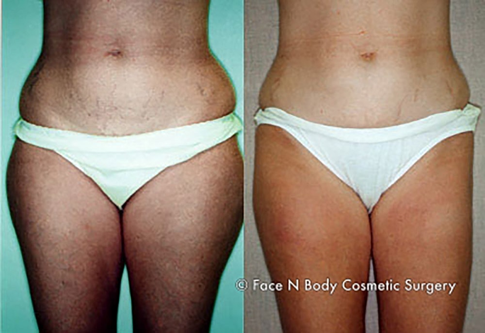 Liposuction Before & After