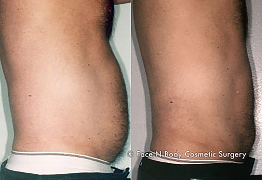 Liposuction Before & After