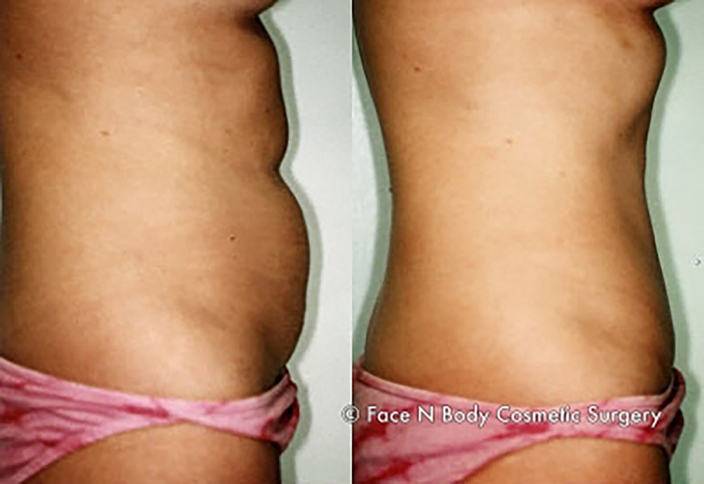 Liposuction Before & After