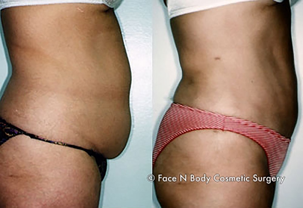 Liposuction Before & After
