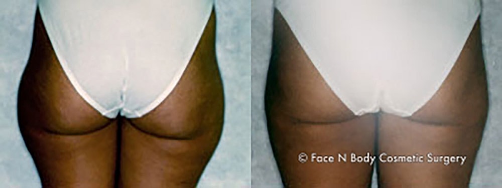 Liposuction Before & After
