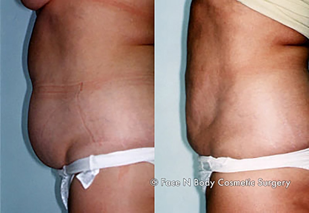 Liposuction Before & After