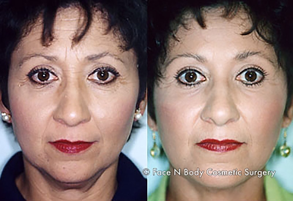 Liposuction Before & After