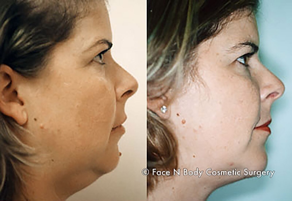 Liposuction Before & After