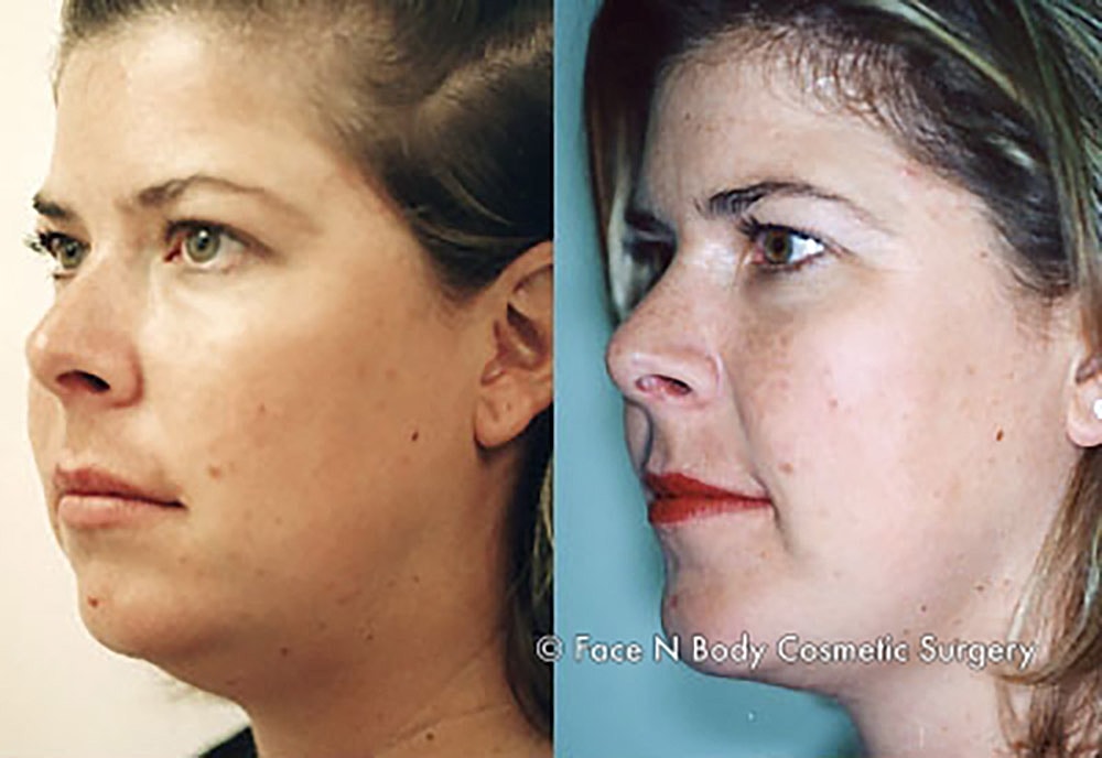 Liposuction Before & After