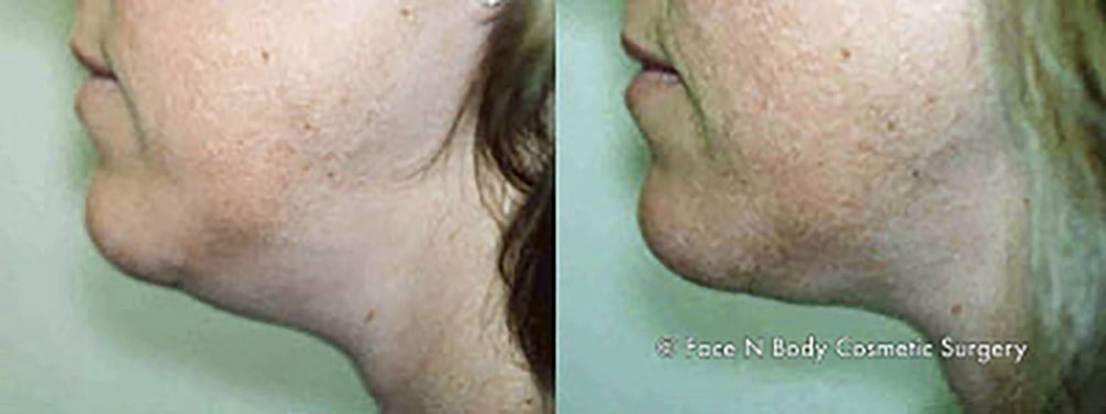 Liposuction Before & After