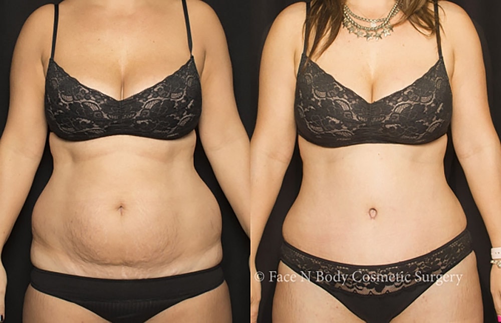 Liposuction Before & After