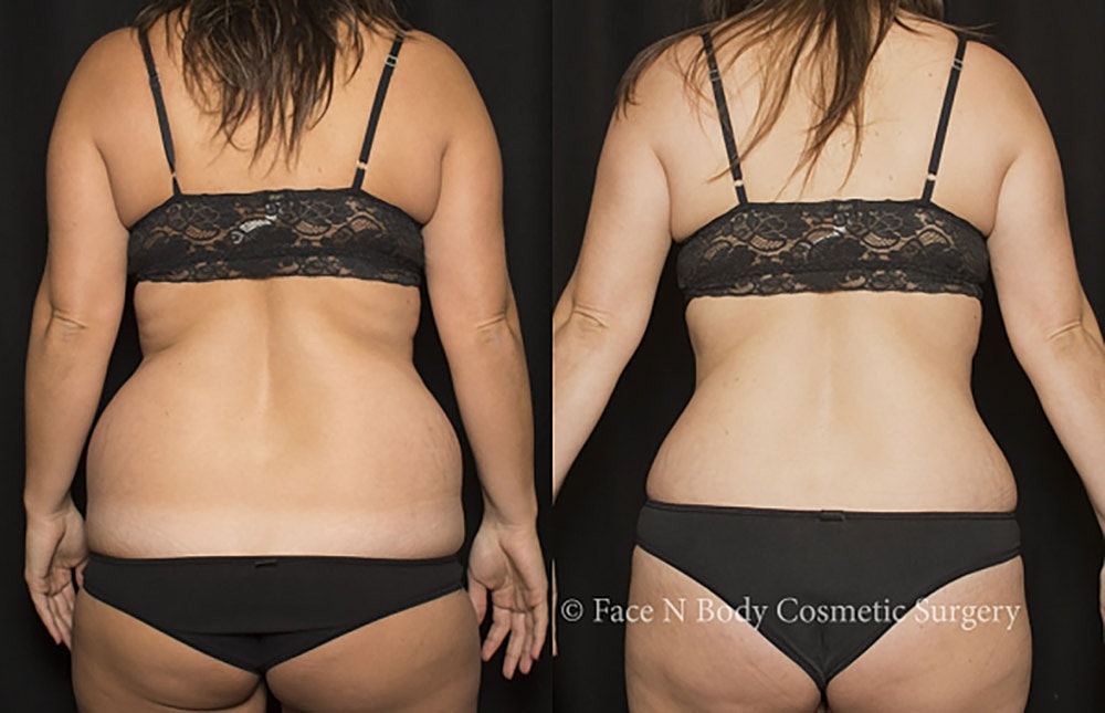 Liposuction Before & After