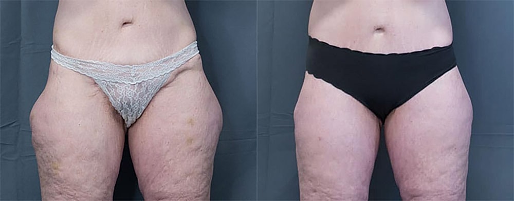 Liposuction Before & After
