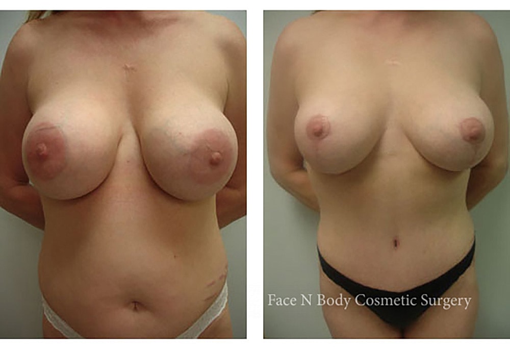 Breast Reduction Before & After