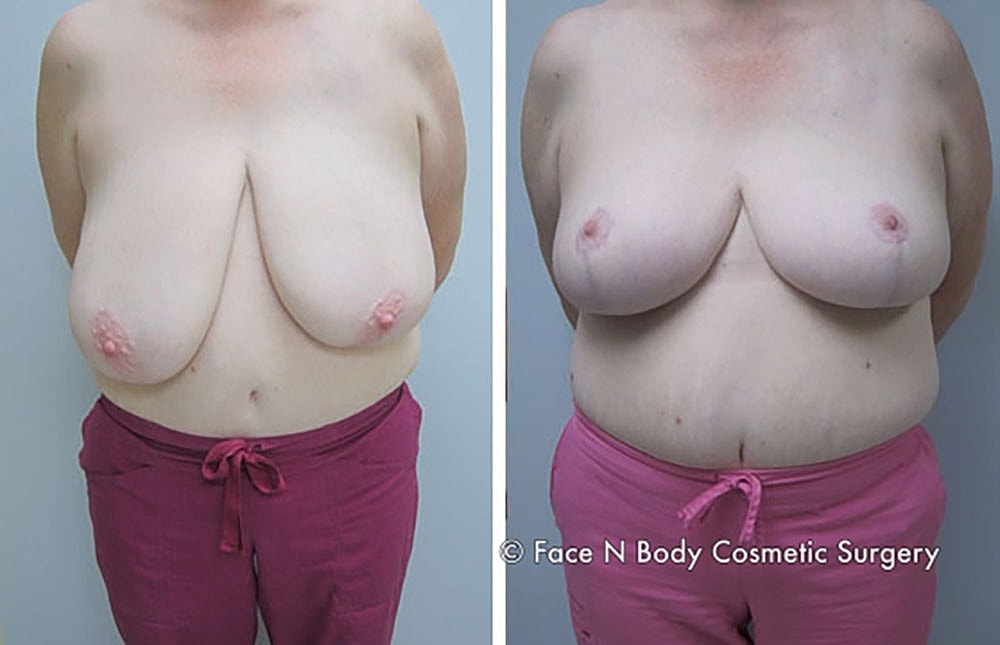 Breast Reduction Before & After