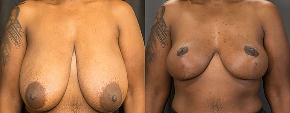 Breast Reduction Before & After
