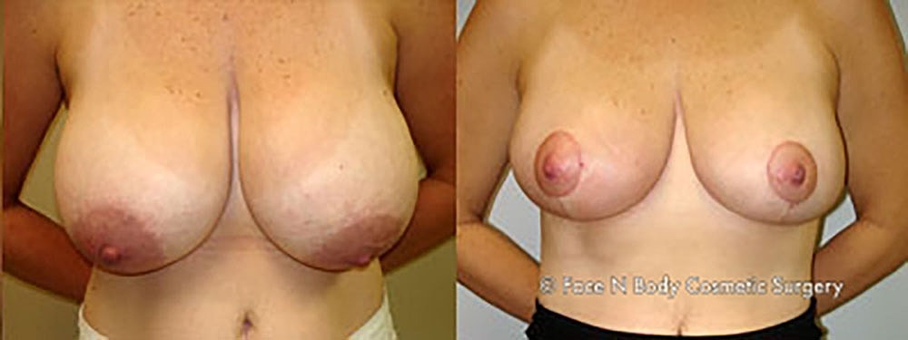 Breast Reduction Before & After