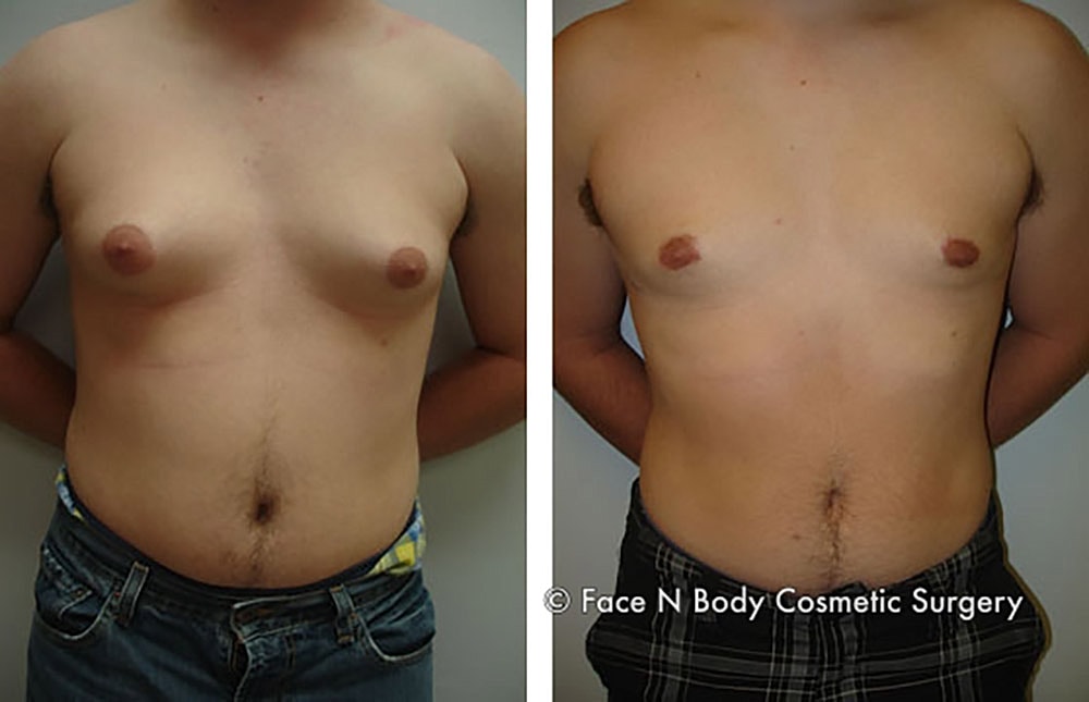 Male Breast Reduction Before & After