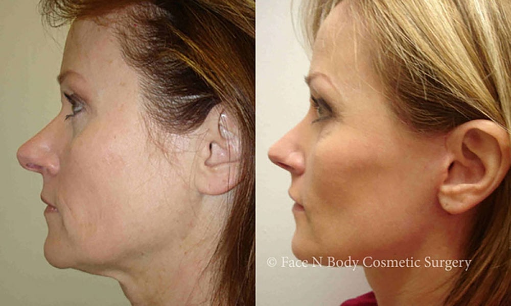 Facelift Before & After