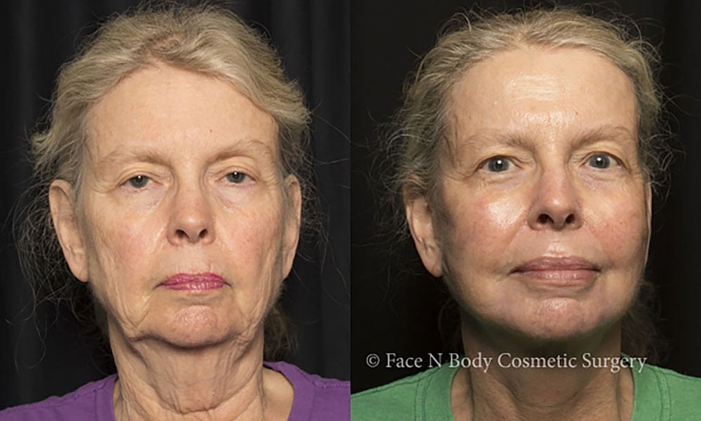 Facelift Before & After