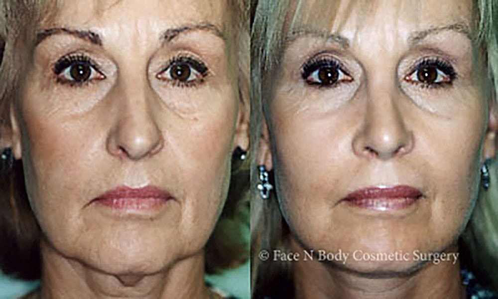 Facelift Before & After