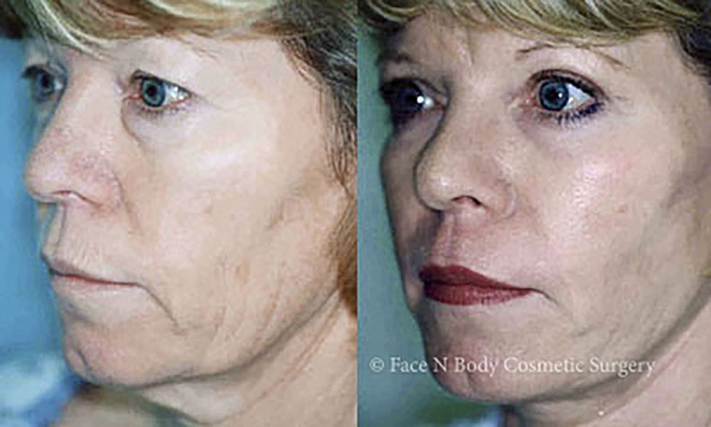 Facelift Before & After
