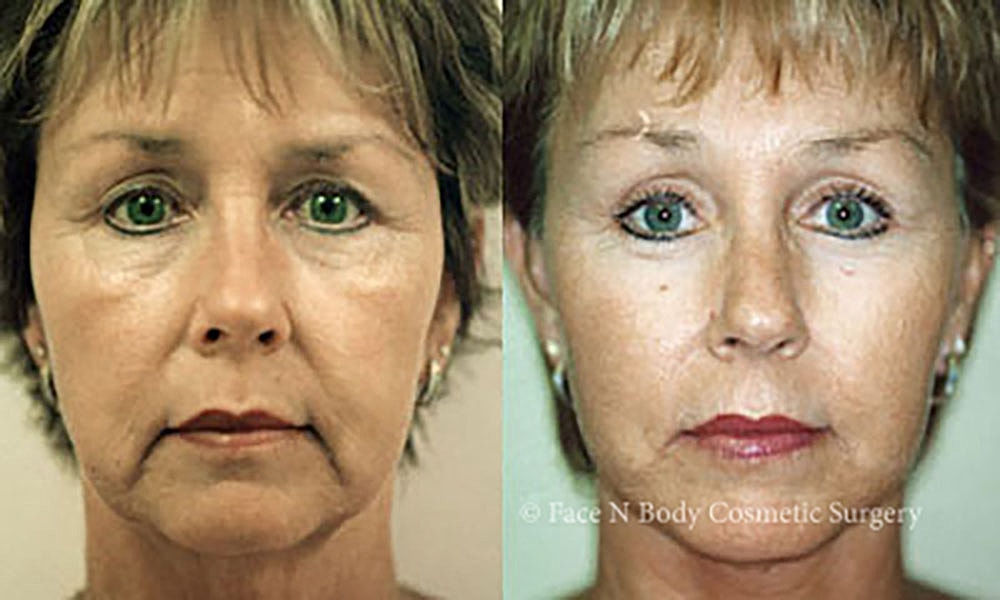Facelift Before & After