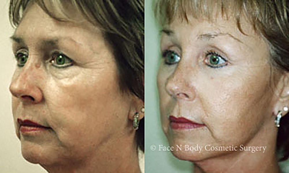 Facelift Before & After