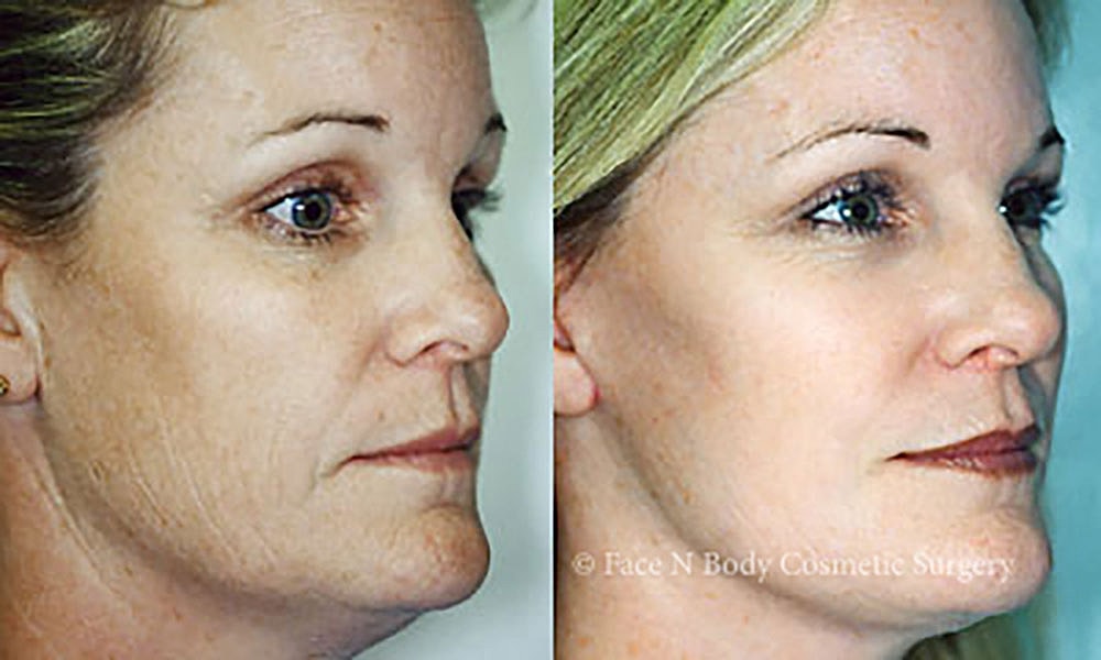 Facelift Before & After