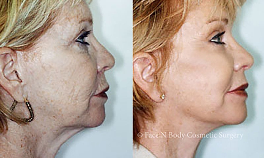 Facelift Before & After