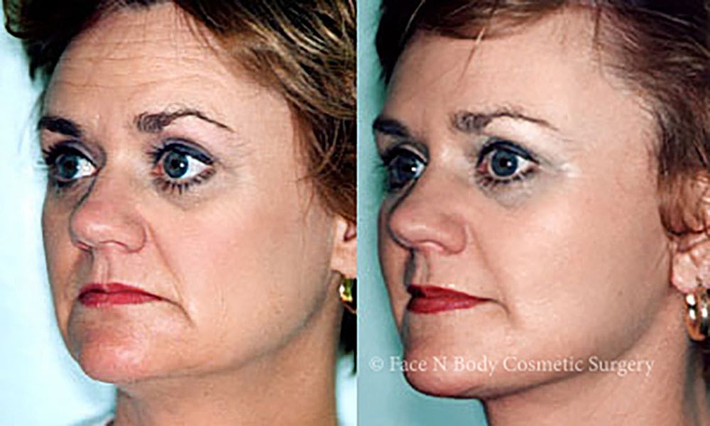 Facelift Before & After