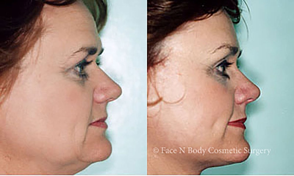 Facelift Before & After