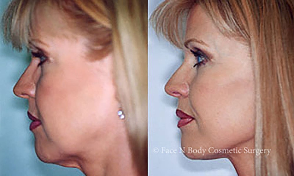 Facelift Before & After