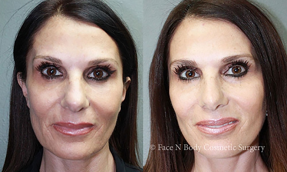 Facelift Before & After