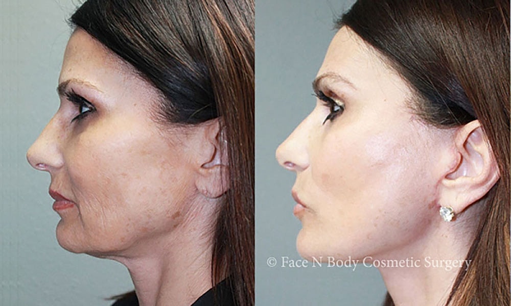 Facelift Before & After