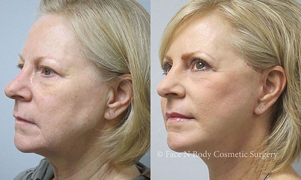 Facelift Before & After