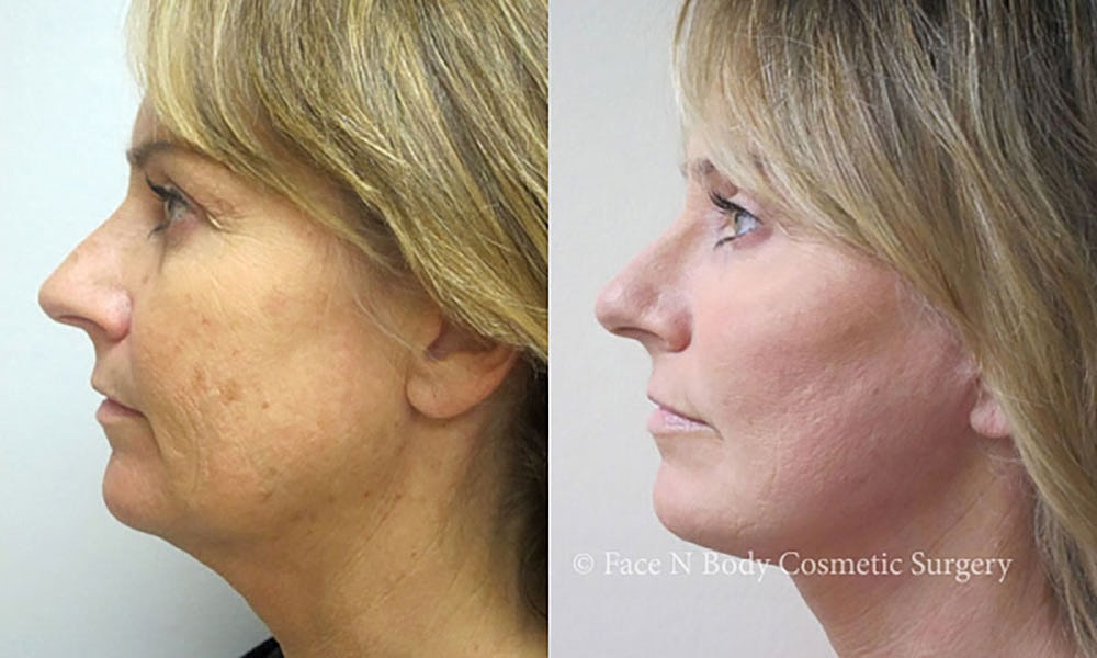 Facelift Before & After