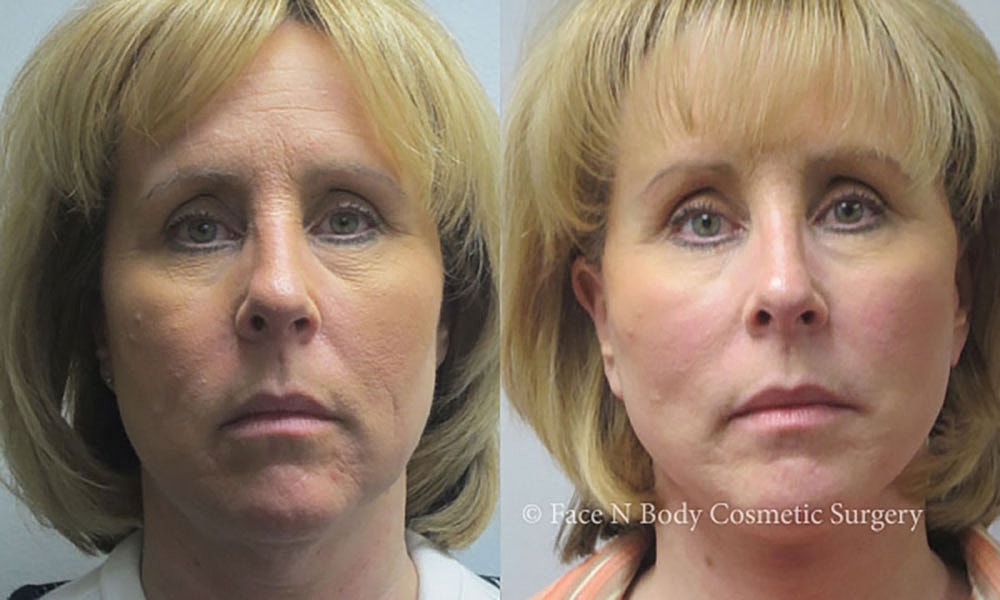 Facelift Before & After