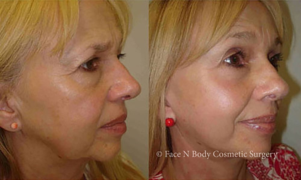 Facelift Before & After
