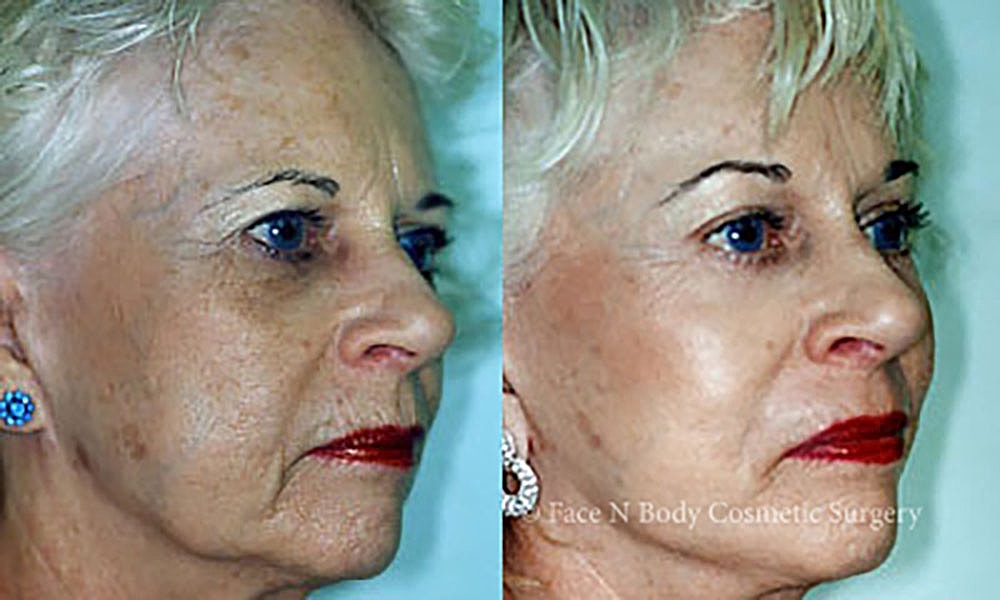 Facelift Before & After