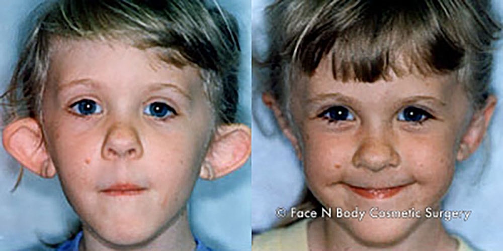 Ear Pinning Before & After