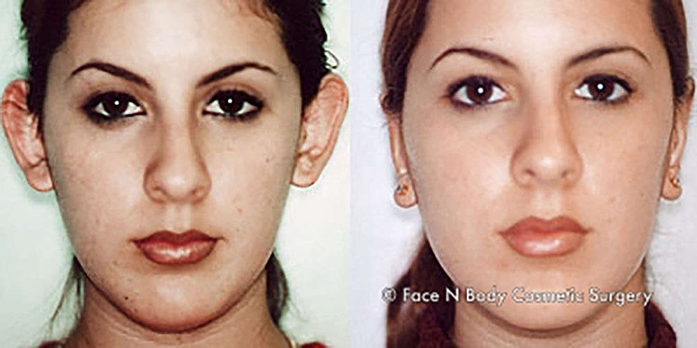 Ear Pinning Before & After