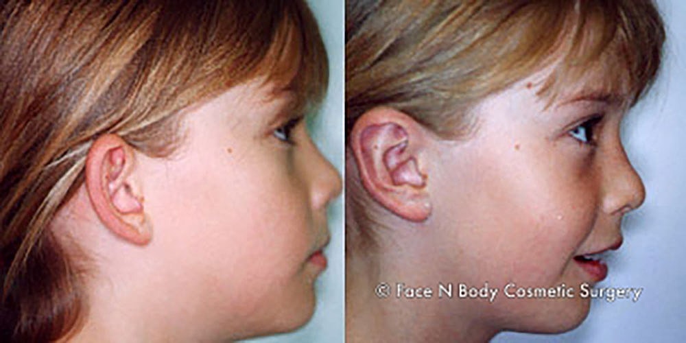 Ear Pinning Before & After