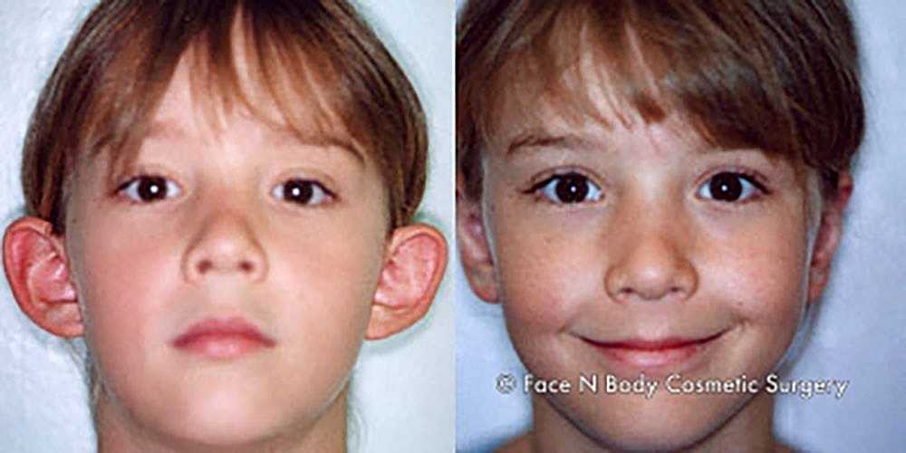 Ear Pinning Before & After