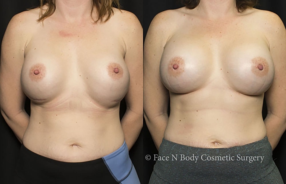 Breast Revision Before & After