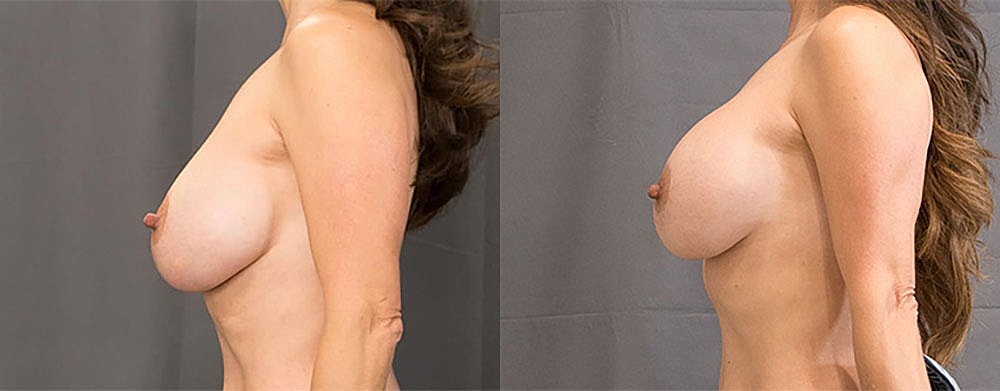 Breast Revision Before & After