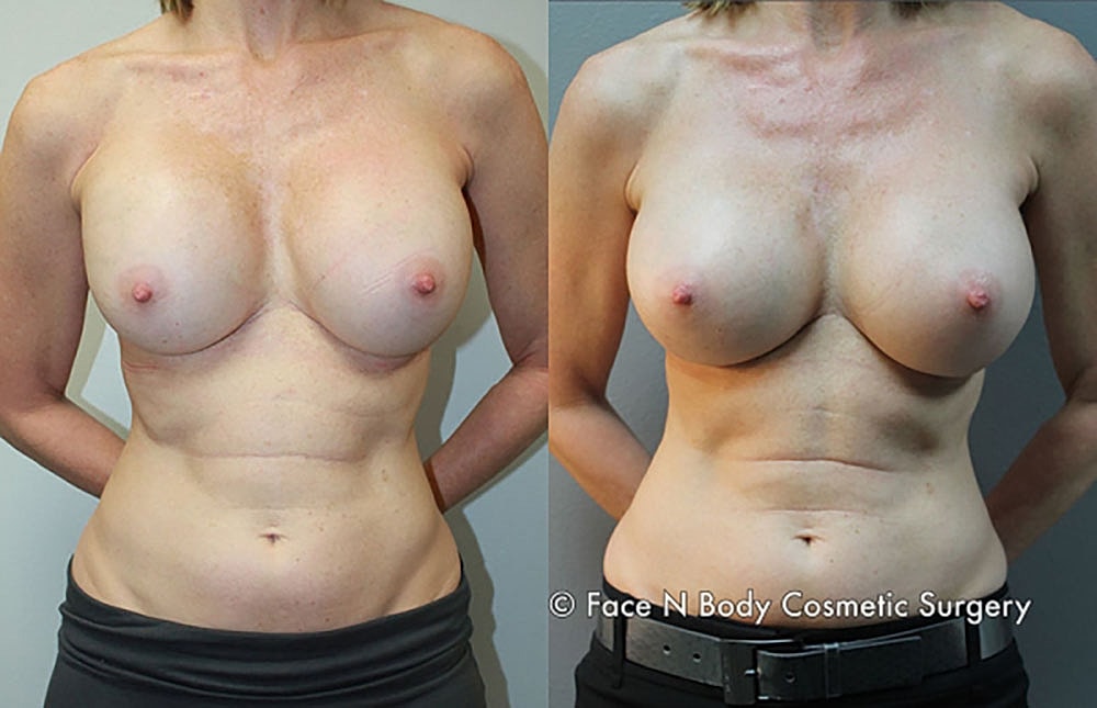 Breast Revision Before & After