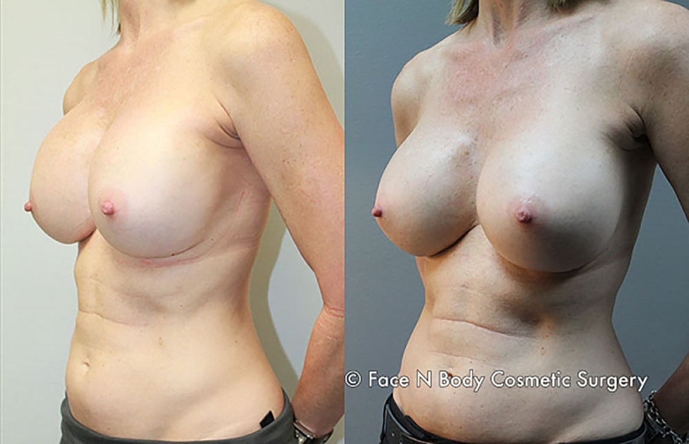 Breast Revision Before & After