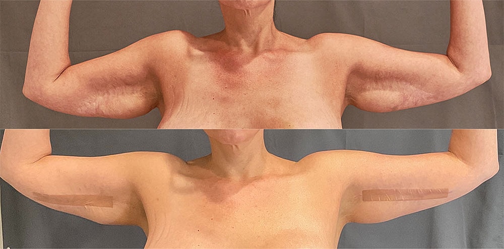 Brachioplasty Before & After