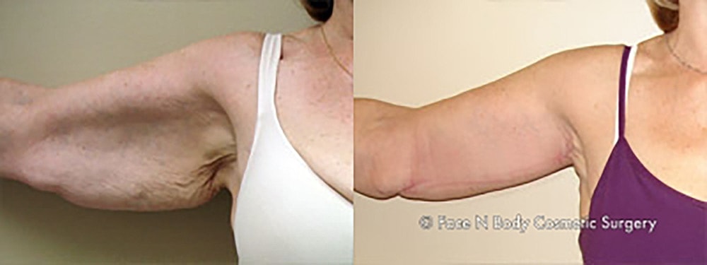 Brachioplasty Before & After