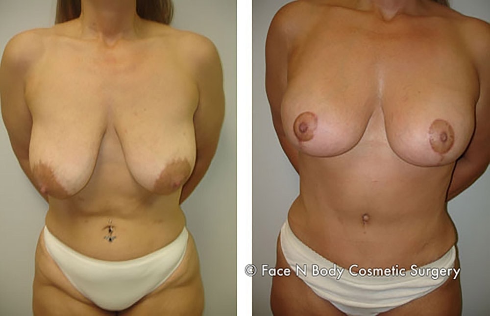 Mommy Makeover Before & After