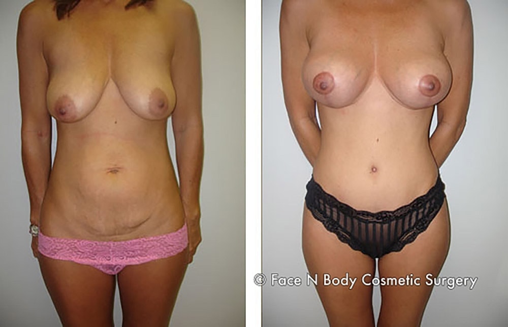 Mommy Makeover Before & After